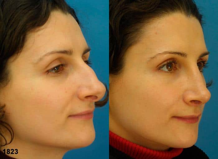 Rhinoplasty to remove dorsal hump and straighten nasal bridge on a female patient by Dr. Miller. After surgery, nose is straighter to improve patient's facial profile.