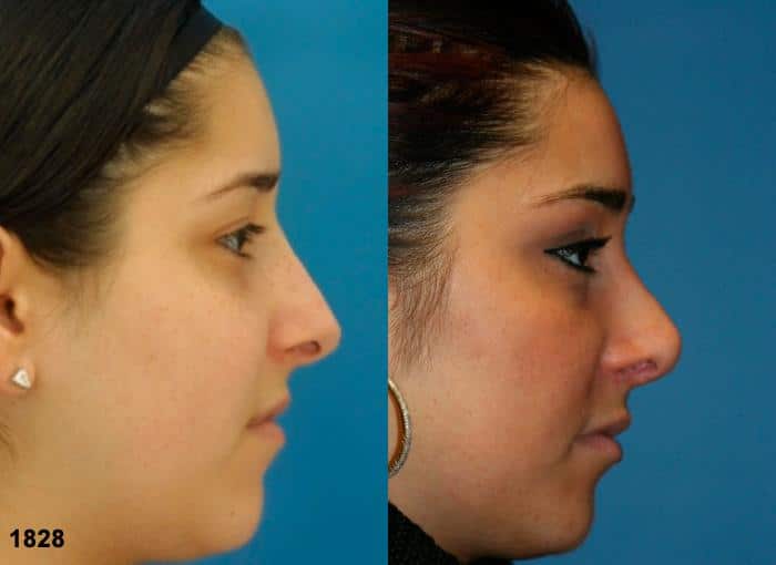 Rhinoplasty to refine the nasal bridge and tip on a female patient by Dr. Miller. Surgery creates more feminine slope to the nose and rounds the tip to improve the facial profile.
