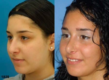 patient-12053-rhinoplasty-nosejob-before-after-3