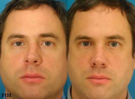 patient-12058-rhinoplasty-nosejob-before-after-2