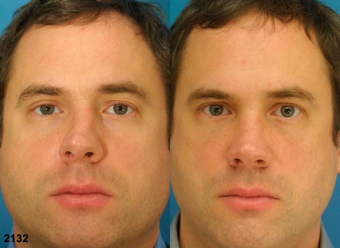 Rhinoplasty to straighten nasal bridge on a male patient by Dr. Miller. After surgery, nose is straighter, bringing balance and proportion to the facial contour.