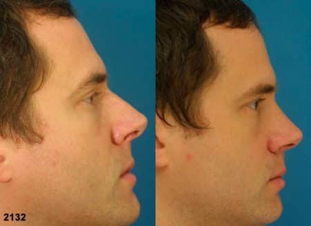 patient-12058-rhinoplasty-nosejob-before-after-3