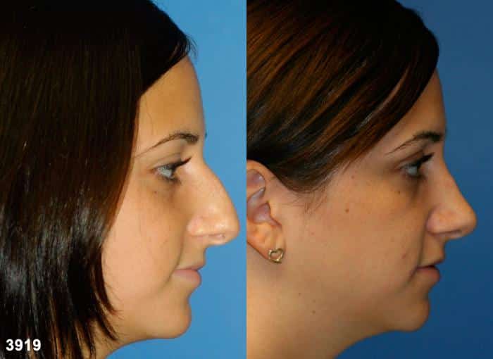 Rhinoplasty to remove dorsal hump and straighten nasal bridge on a female patient by Dr. Miller. Surgery creates a smoother nasal bridge and refines the tip to produce an enhanced facial profile.