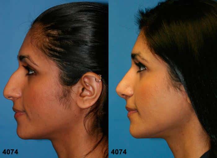 Ethnic rhinoplasty to remove dorsal hump and straighten nasal bridge on a female patient by Dr. Miller. Surgery straightens bridge, eliminates bump, and refines tip to improve the patient's facial profile.