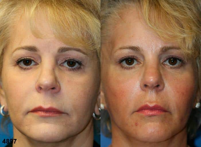 Rhinoplasty to address nose asymmetry in a female patient by Dr. Miller. Surgery creates balance between two side of nose while refining nasal tip.