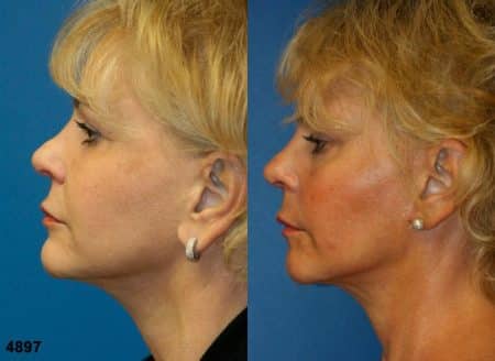 patient-12073-rhinoplasty-nosejob-before-after-5