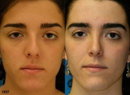 patient-12080-rhinoplasty-nosejob-before-after-3