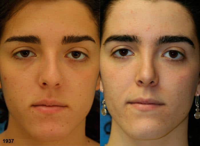 Rhinoplasty to straighten nasal bridge of a female patient by Dr. Miller. Surgery creates straighter bridge to produce better balance and symmetry in the facial contour.