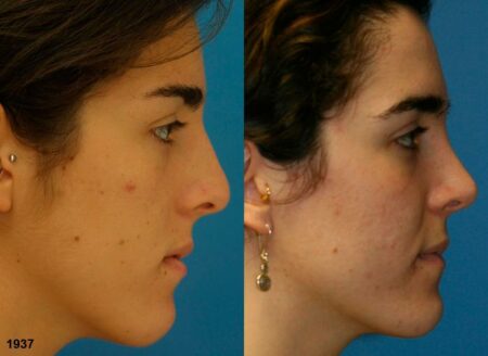 Rhinoplasty to correct nasal bridge and improve facial profile of a female patient by Dr. Miller