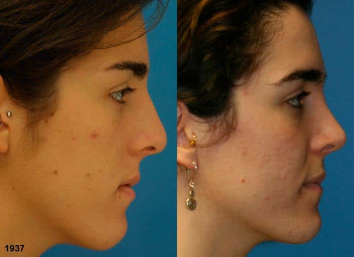 Rhinoplasty to correct nasal bridge and improve facial profile of a female patient by Dr. Miller. Surgery straightens nasal bridge and rotates tip to create a more aesthetically pleasing facial profile.