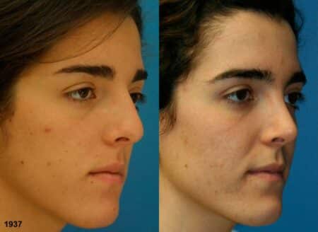 Rhinoplasty to correct nasal bridge and improve facial profile of a female patient by Dr. Miller