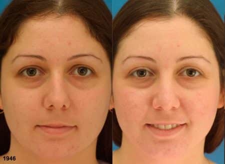 patient-12087-rhinoplasty-nosejob-before-after-3