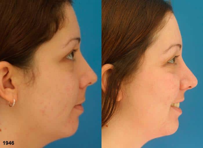 ski slope rhinoplasty before and after