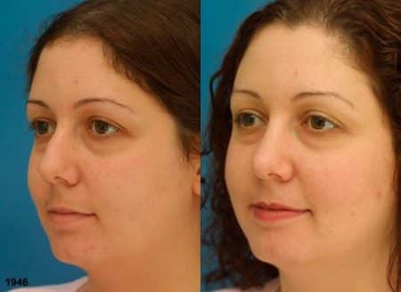 patient-12087-rhinoplasty-nosejob-before-after-5