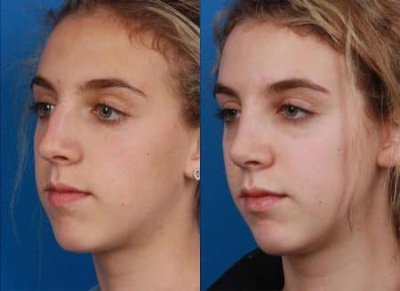 patient-12094-rhinoplasty-nosejob-before-after-7