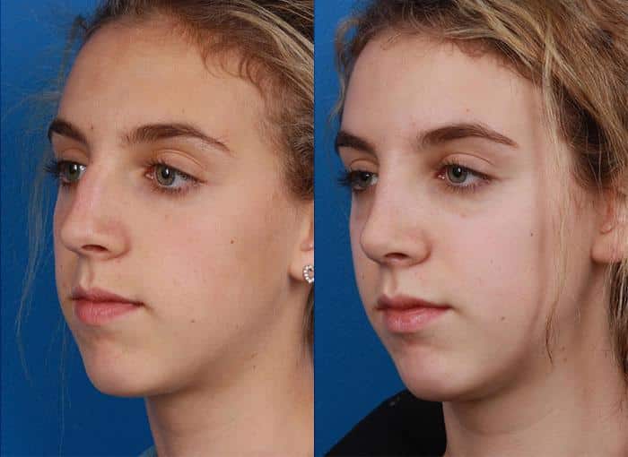 Rhinoplasty to remove a bump from the nasal bridge and enhance the facial profile of a female patient by Dr. Miller. Surgery creates a straighter nasal bridge.