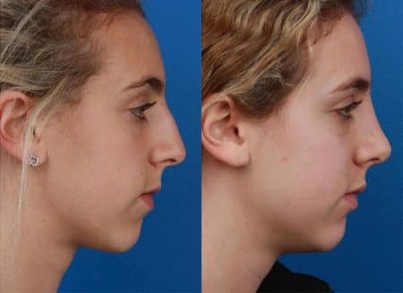 patient-12094-rhinoplasty-nosejob-before-after-8