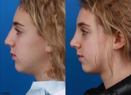 patient-12094-rhinoplasty-nosejob-before-after-9