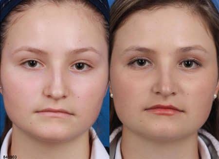 patient-12105-rhinoplasty-nosejob-before-after-4