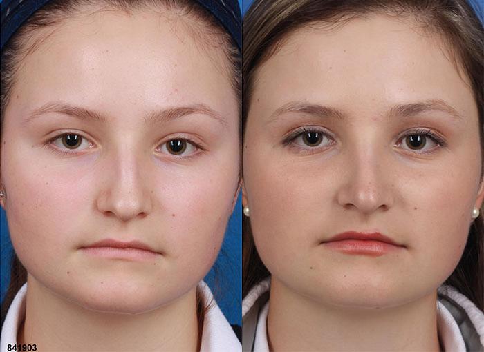 Rhinoplasty to straighten nasal bridge of a female patient by Dr. Miller. Surgery creates straighter line to the nose to balance the facial contour.