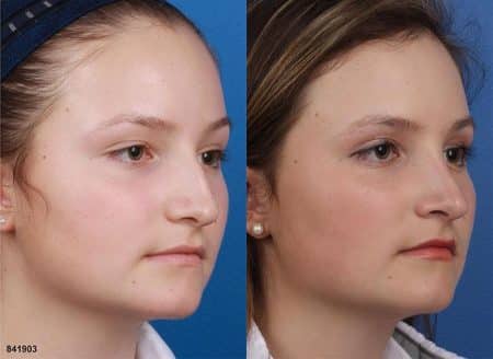 patient-12105-rhinoplasty-nosejob-before-after-5