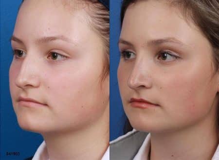 patient-12105-rhinoplasty-nosejob-before-after-6