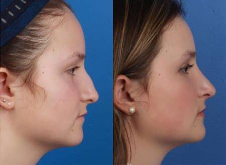 patient-12105-rhinoplasty-nosejob-before-after-7