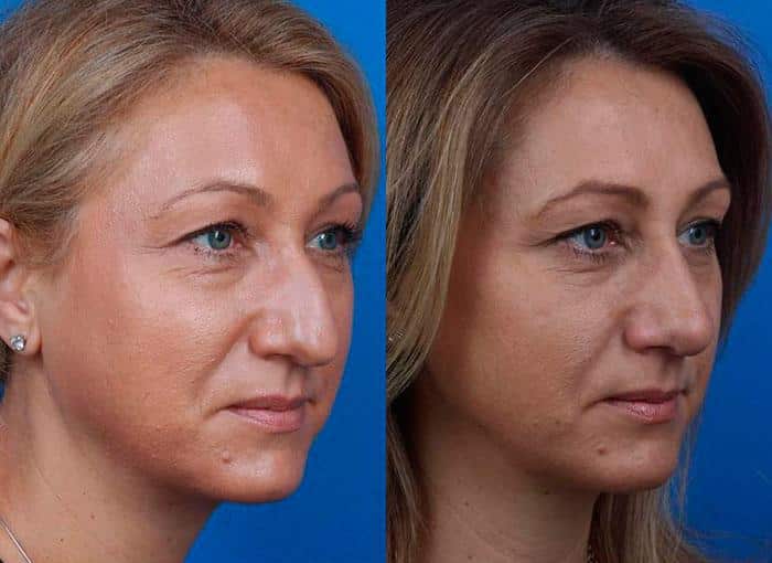 Rhinoplasty to remove a bump from the nasal bridge and enhance the facial profile of a female patient by Dr. Miller. After surgery, nasal bridge is straighter and tip is rotated and refined.