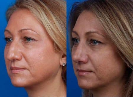 patient-12123-rhinoplasty-nosejob-before-after-6