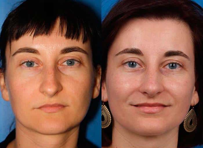 Rhinoplasty to strengthen nasal bridge and refine tip of a female patient by Dr. Miller. Surgery creates a more symmetrical tip and widens the bridge to produce a more proportionate feature.