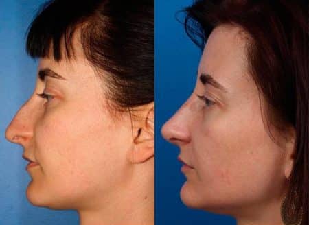 patient-12132-rhinoplasty-nosejob-before-after-3