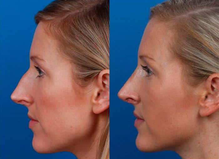 Rhinoplasty to correct nasal bridge and improve facial profile of a female patient by Dr. Miller. After surgery, nose is straighter and tip is slightly rotated and refined.