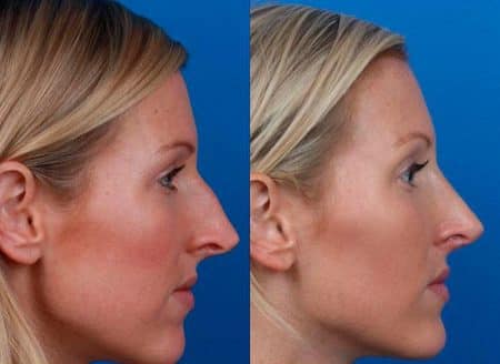 patient-12137-rhinoplasty-nosejob-before-after-5