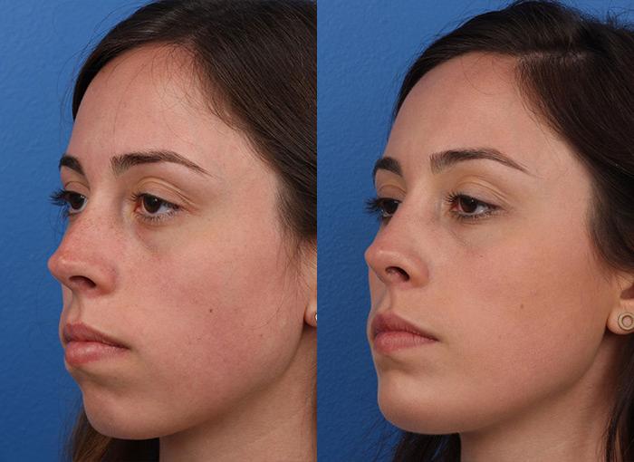 Rhinoplasty to remove a bump from the nasal bridge and enhance the facial profile of a female patient by Dr. Miller. After surgery, bump is gone and nose is straighter with an enhanced shape.