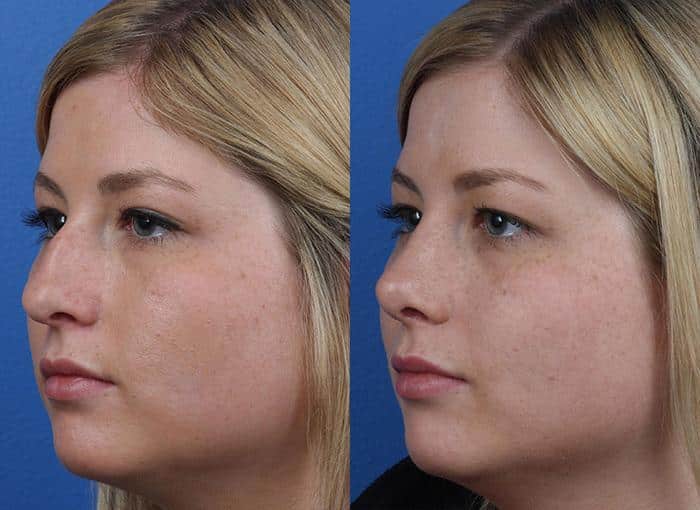 Rhinoplasty to remove a bump from the nasal bridge and enhance the facial profile of a female patient by Dr. Miller. Surgery removes hump and creates a straighter nose shape while tip is slightly rotated and refined.