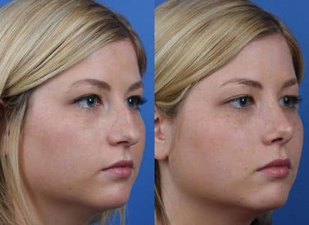 patient-12158-rhinoplasty-nosejob-before-after-5