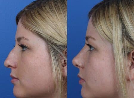 patient-12158-rhinoplasty-nosejob-before-after-6