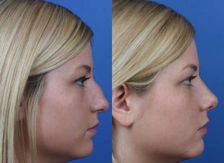 patient-12158-rhinoplasty-nosejob-before-after-7