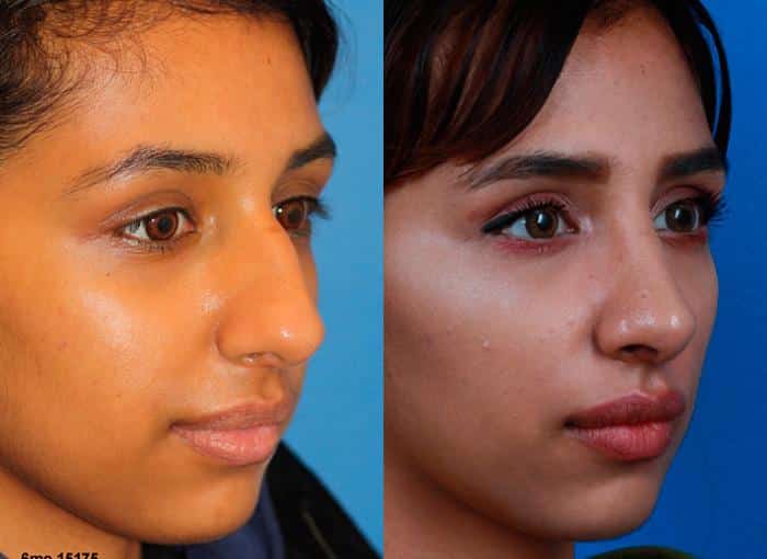 Ethnic rhinoplasty to remove the dorsal hump from the nose of a female patient by Dr. Miller. Surgery creates straighter nasal bridge and rotates the sip slightly to enhance the profile.