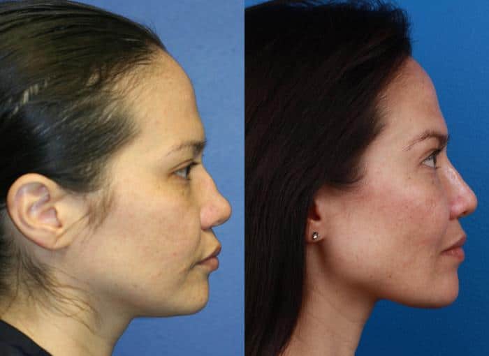 Rhinoplasty to remove dorsal hump and straighten nasal bridge on a female patient by Dr. Miller. Once hump is removed, nose has a more feminine shape and profile.