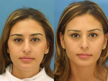 Rhinoplasty to refine the nasal bridge and tip on a female patient by Dr. Miller. Surgery straightens bridge and rotates nasal tip slightly to create a more feminine shape to the nose.