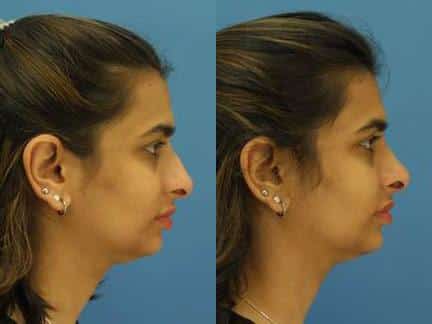 Rhinoplasty to refine the nasal bridge and enhance the size and shape of the nose of a female patient by Dr. Miller. Nose profile is improved after surgery with a straighter bridge and refined tip.
