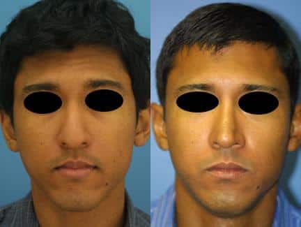 Ethnic rhinoplasty to improve the size and shape of the nose of a male patient by Dr. Miller. Surgery narrows nasal bridge at tip to create a more proportionate shape to the nose.