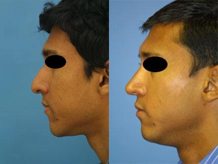 patient-12193-ethnic-rhinoplasty-before-after-5