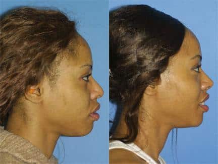 patient-12200-ethnic-rhinoplasty-before-after-7