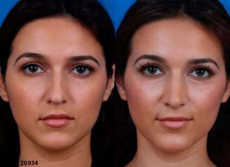 patient-12219-ethnic-rhinoplasty-before-after-2