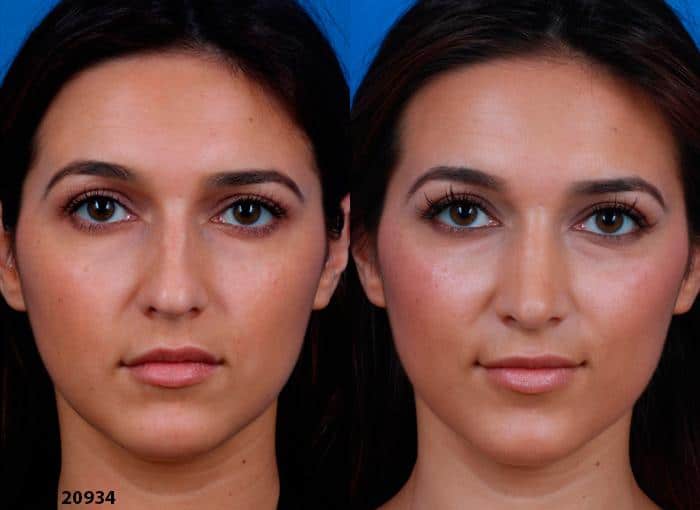 Ethnic rhinoplasty to strengthen the shape of the nose of a female patient by Dr. Miller. After surgery, nasal bridge is wider and stronger to create a more proportionate feature.
