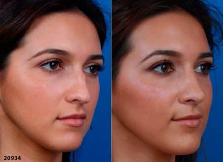 patient-12219-ethnic-rhinoplasty-before-after-3