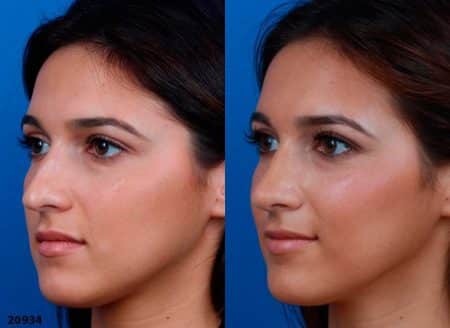 patient-12219-ethnic-rhinoplasty-before-after-4