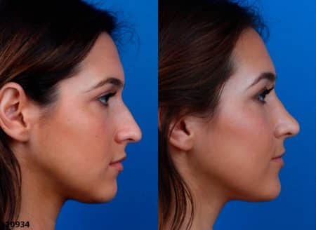 patient-12219-ethnic-rhinoplasty-before-after-5